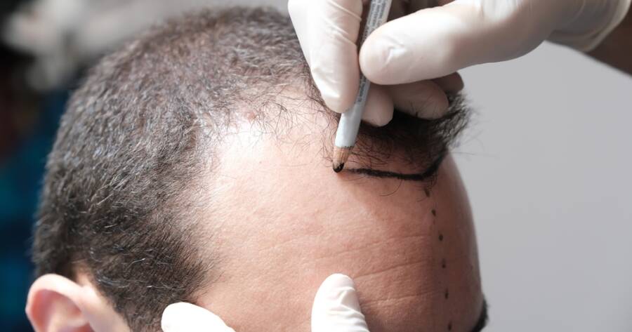 Choosing Between FUT and FUE Hair Transplants